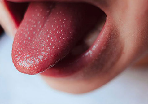 川崎病1期症状草莓舌红肿带红斑的舌头