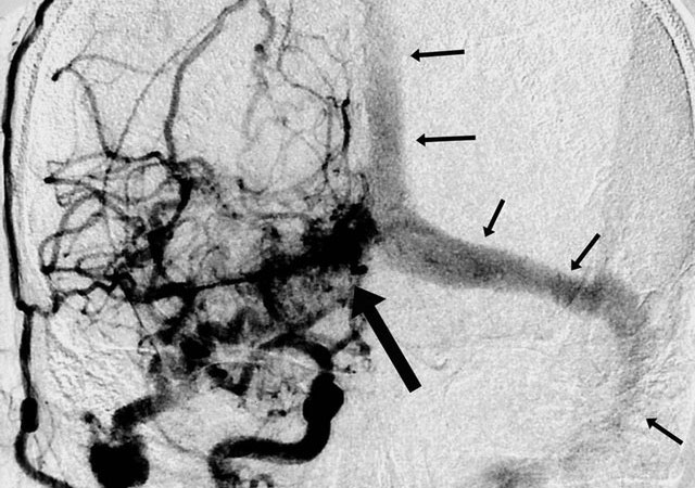 硬脑膜动静脉瘘