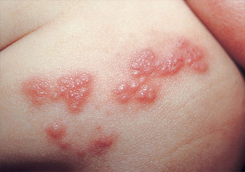 带状疱疹是由同一种病毒,水痘-带状疱疹病毒引起的.