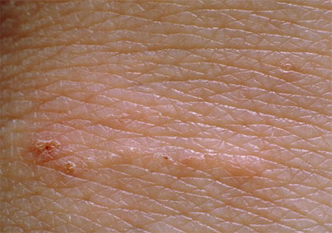 疥疮是什么样子疥虫感染初期小红点和爬过的痕迹症状图片