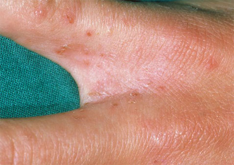 疥疮是什么样子疥虫感染初期小红点和爬过的痕迹症状