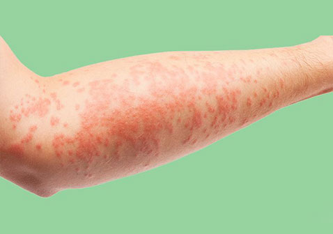 6种湿疹的类型和症状辨别图片大全