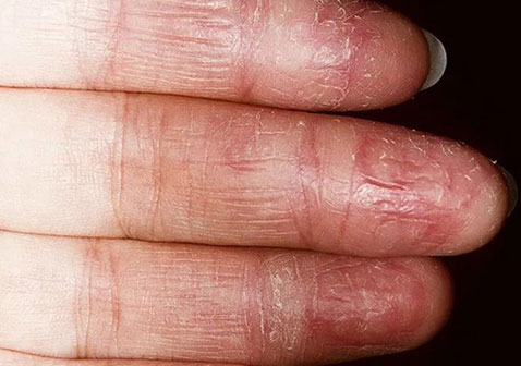 手上的真菌性湿疹,开裂,有鳞片,发红等症状
