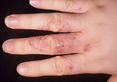 手藓类皮肤病图片早期症状