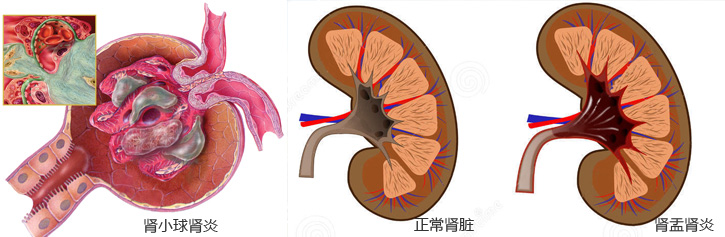 尿毒症诱因-肾小球肾炎、肾盂肾炎（图）