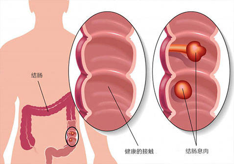 患有多个结肠息肉的人经常接受加德纳综合征检查