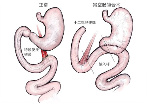 盲袢综合征是什么原因引起的症状并发症及治疗