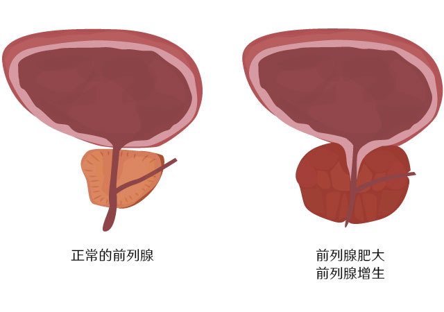 正常的前列腺与前列腺肥大对比图