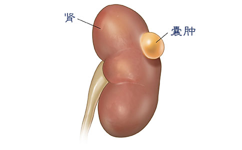 肾囊肿吃什么药能消除及最佳治疗方法？