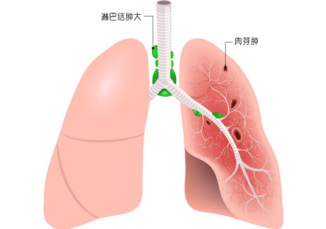 肺肉芽肿的症状有哪些什么原因引起的怎么治疗