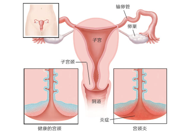 宫颈炎有哪些症状吃什么药能治好最佳治疗方法