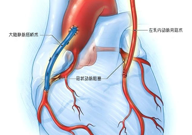 什么心脏搭桥手术及类型风险替代方法