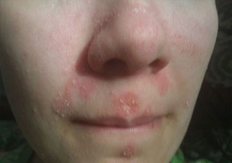 脸部牛皮肤癣图片初期症状和治疗药膏