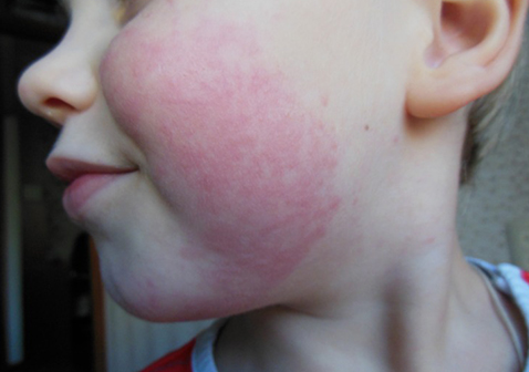 儿童9种常见的皮肤病图片荨麻疹图片