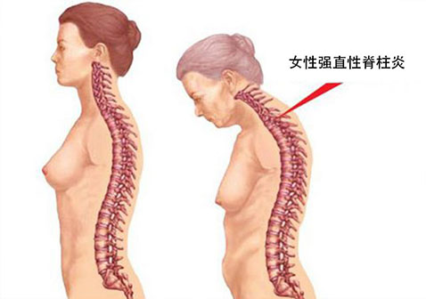 与男性不同，女性强直性脊柱炎症状表现在肩关节