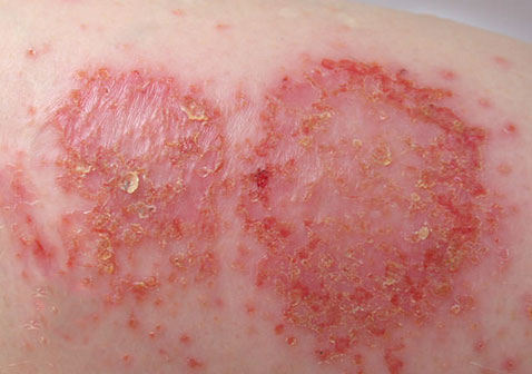 角化湿疹的症状图片图片