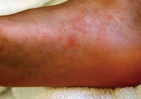脚上怎么分辨是湿疹还是脚气图片