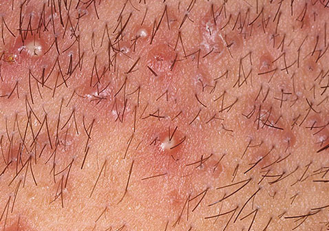 红色丘疹:皮囊炎症状初期表现为以毛囊为中心的米粒大小的红色丘疹