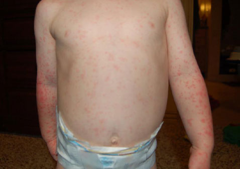 儿童9种常见的皮肤病图片9猩红热图片