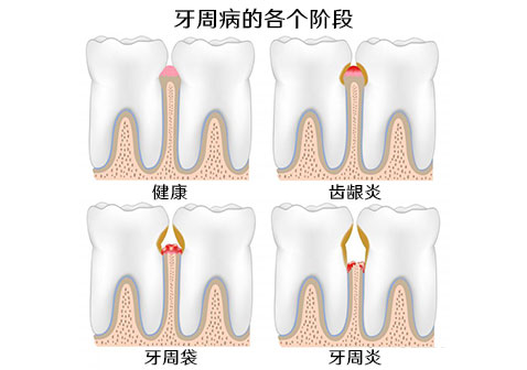 牙龈痛图片牙周炎