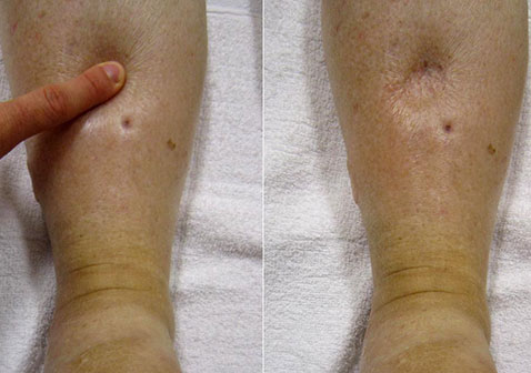 凹陷性水肿图片