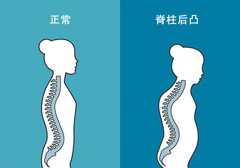 脊柱后凸图片