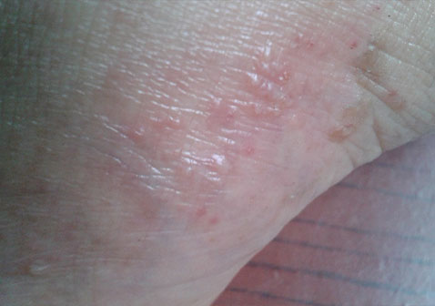 脚红斑丘疹型湿疹图片