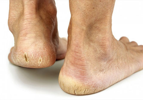 脚皲裂型湿疹图片