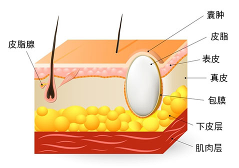 皮下囊肿示意图片
