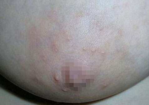 乳房湿疹图片初期症状图片