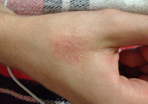 手部湿疹图片初期症状图片