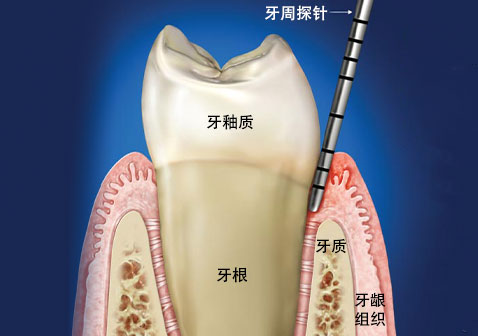 牙周探针检测示意图