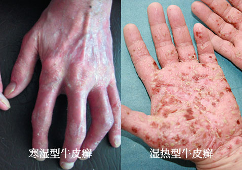 寒湿型牛皮癣与湿热型牛皮癣图片对比